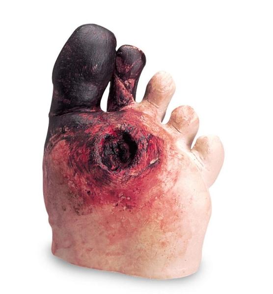 Erler-Zimmer Diabetes Fuß