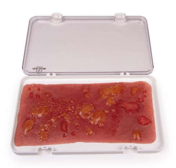 Erler-Zimmer Wundmoulage Verbrennung II. Grades