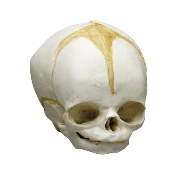 Erler-Zimmer Fetusschädel, 32 Wochen