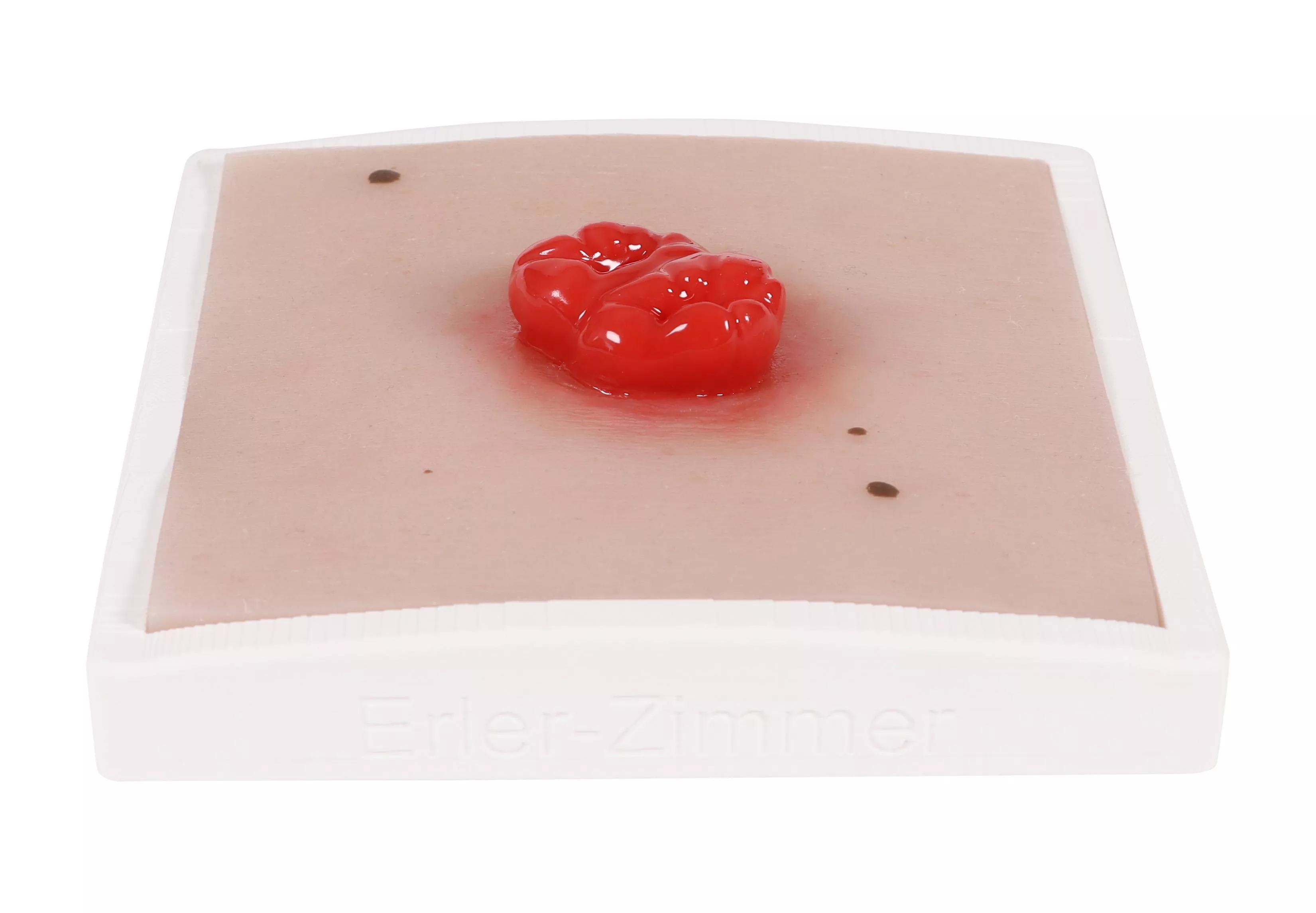 Erler-Zimmer Wundmoulage Kolostoma doppelläufig, inkl. Stativ