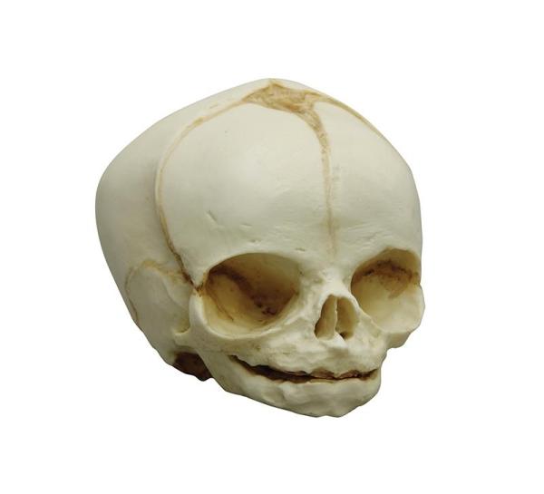 Erler-Zimmer Fetusschädel, 31 Wochen