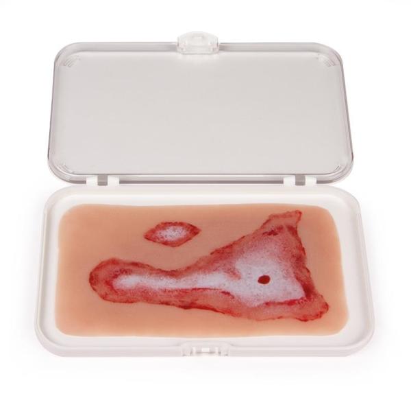 Erler-Zimmer Wundmoulage Verbrühung