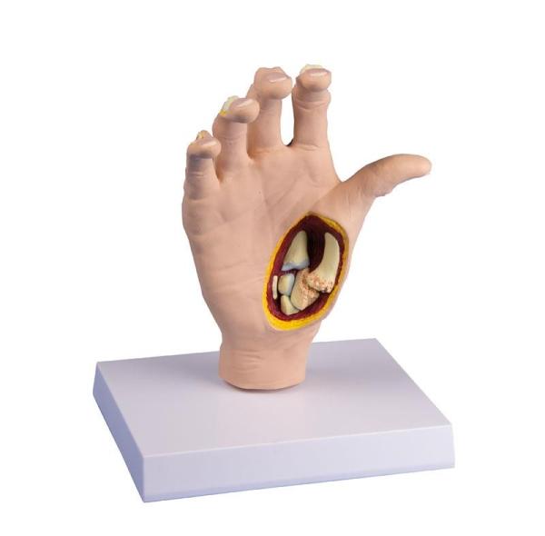 Erler-Zimmer Osteoarthritis (OA) Hand