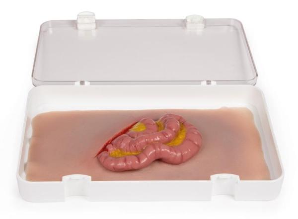 Erler-Zimmer Wundmoulage Dünndarmaustritt