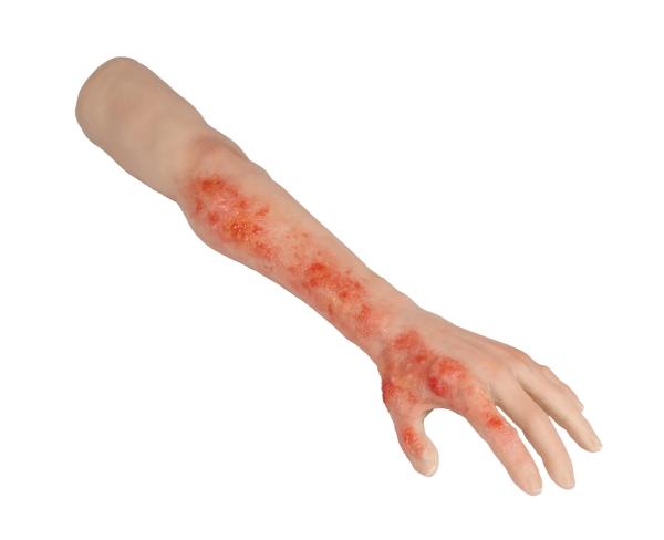 Erler-Zimmer Arm mit Verbrennungen Task-Trainer