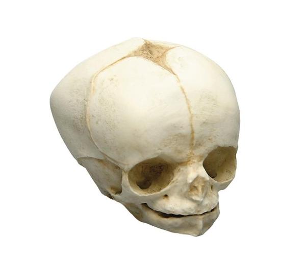 Erler-Zimmer Fetusschädel, 34 Wochen