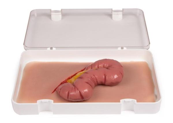 Erler-Zimmer Wundmoulage Dickdarmaustritt