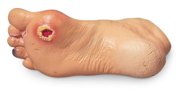 Erler-Zimmer Erweiterte Fußprobleme