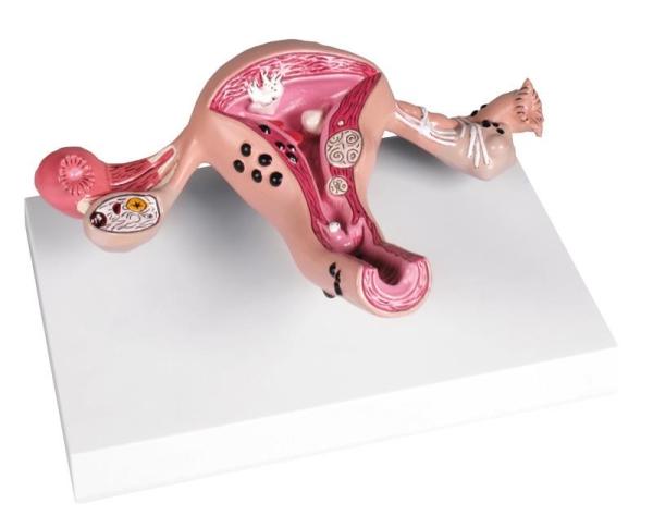 Erler-Zimmer Uterusmodell mit Erkrankungen