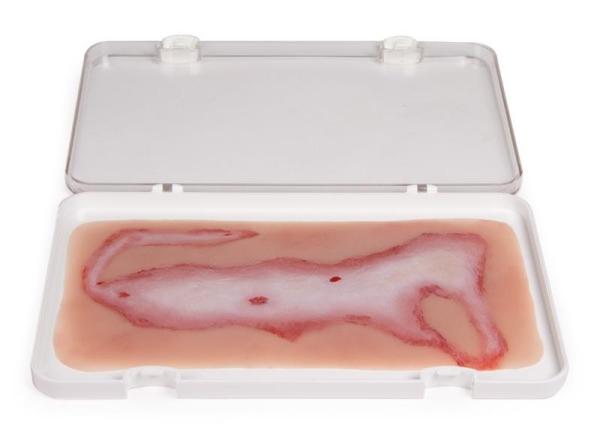 Erler-Zimmer Wundmoulage Verbrühung